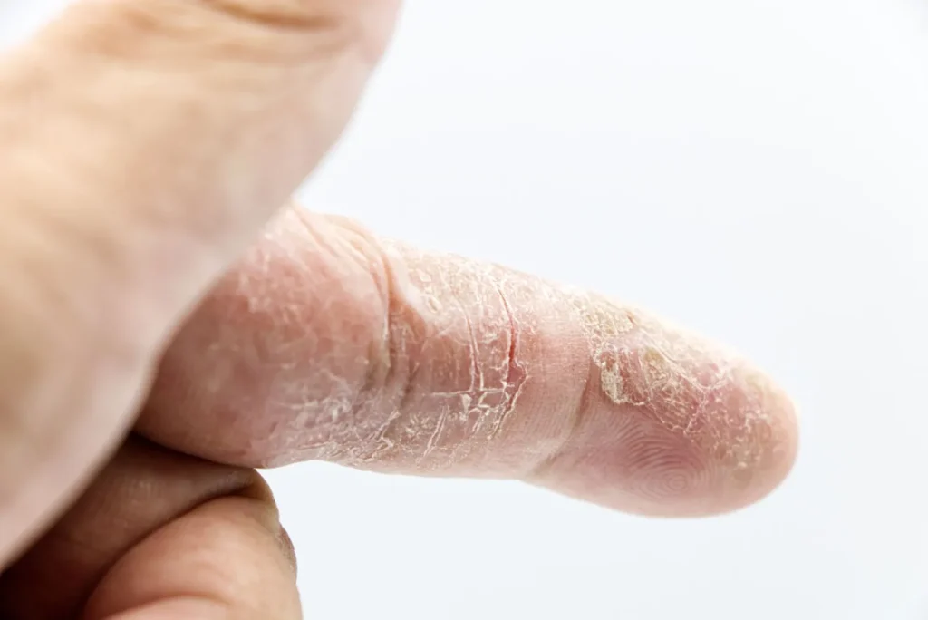 Close-up of dry, tight winter skin on the back of a hand showing the effect of low indoor humidity