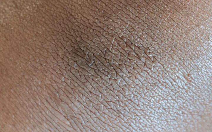 Humidity and Dry Skin Explained